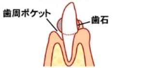 歯周ポケットと歯石