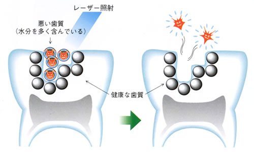 レーザー照射