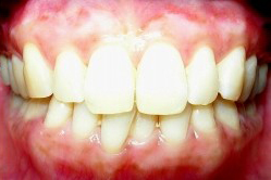 歯茎の黒ずみ治療後